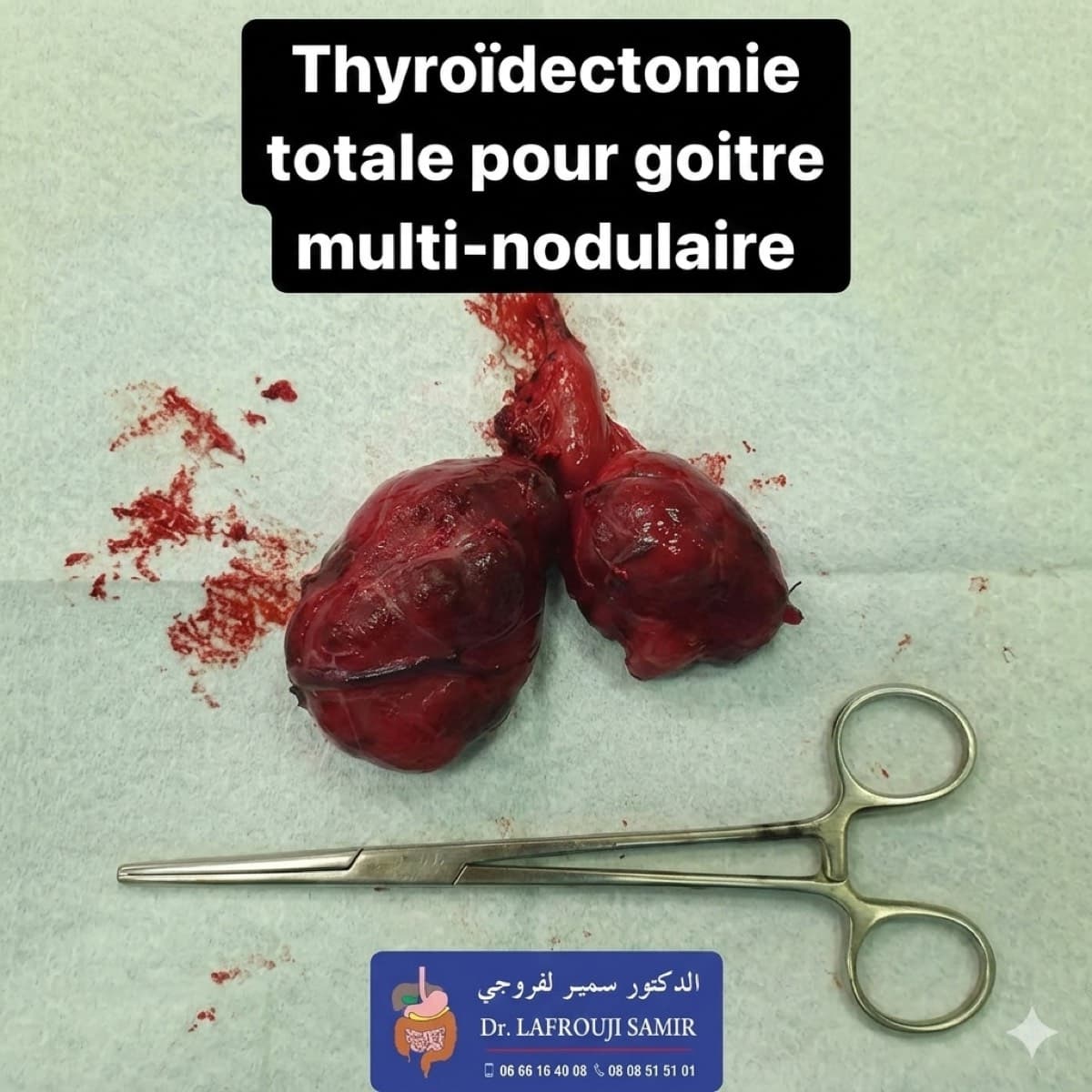 Chirurgie Thyroidienne