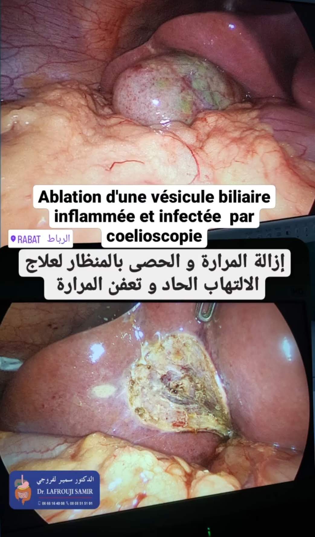 Chirurgie Biliaire