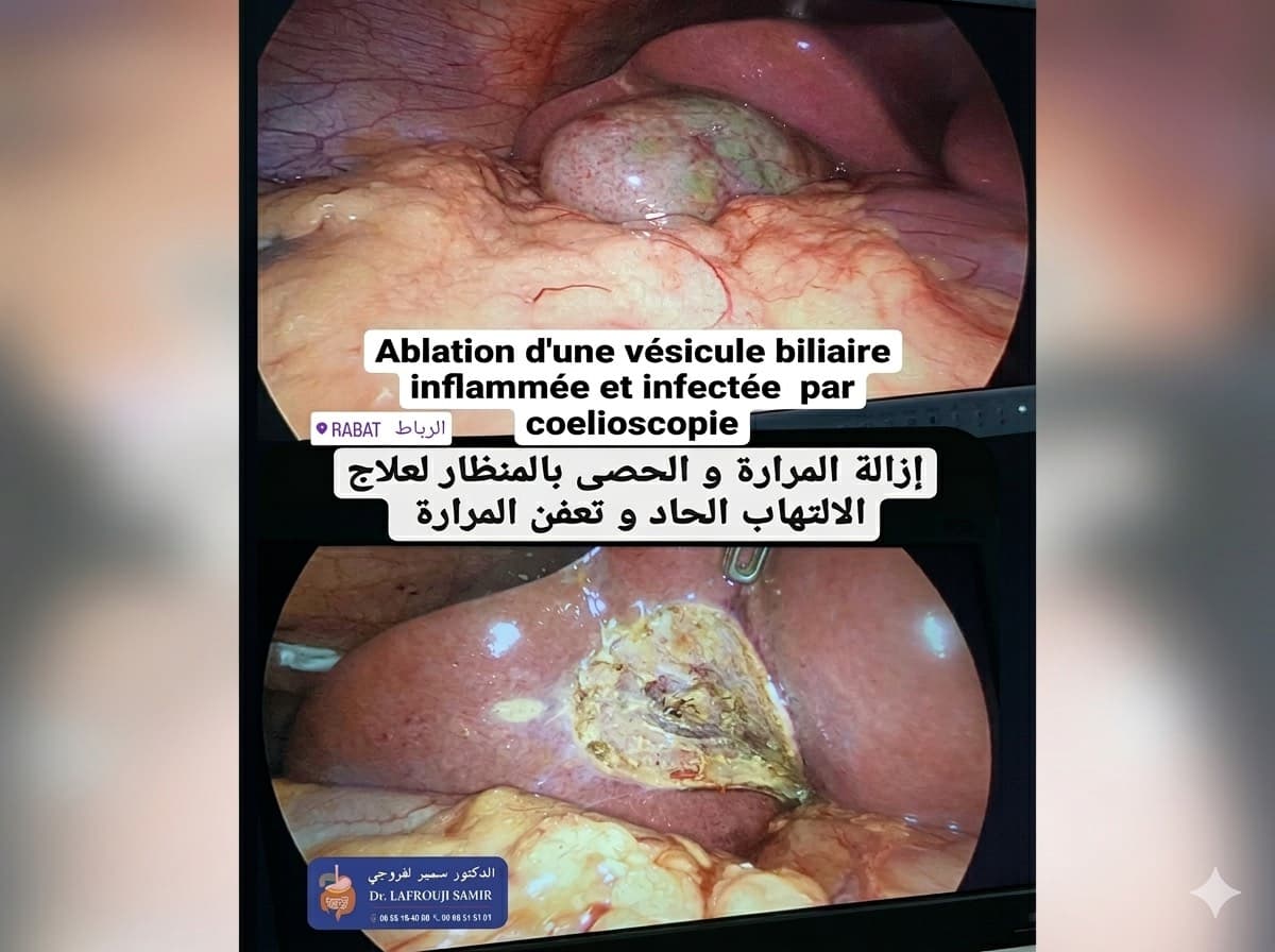 Chirurgie Biliaire