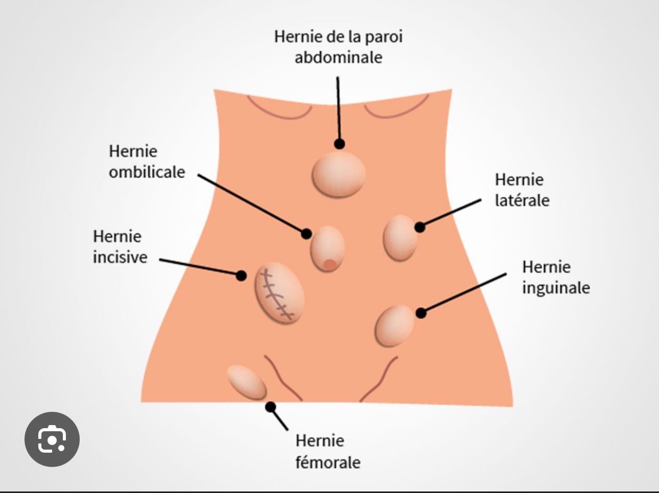 Chirurgie Herniaire